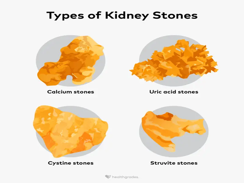 Types of Kidney Stones