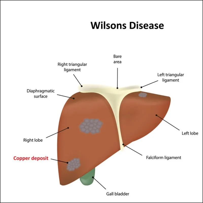 Wilson's Disease and Its Impact on Nutrition